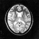 MRIで撮影した脳の断層写真